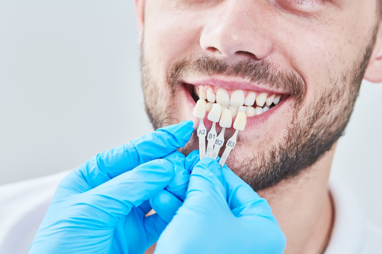 veneers