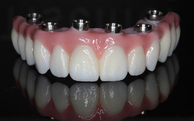 full mouth rehabilitation treatment in somalwada
