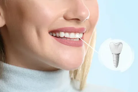 dental implant treatment in dombivli