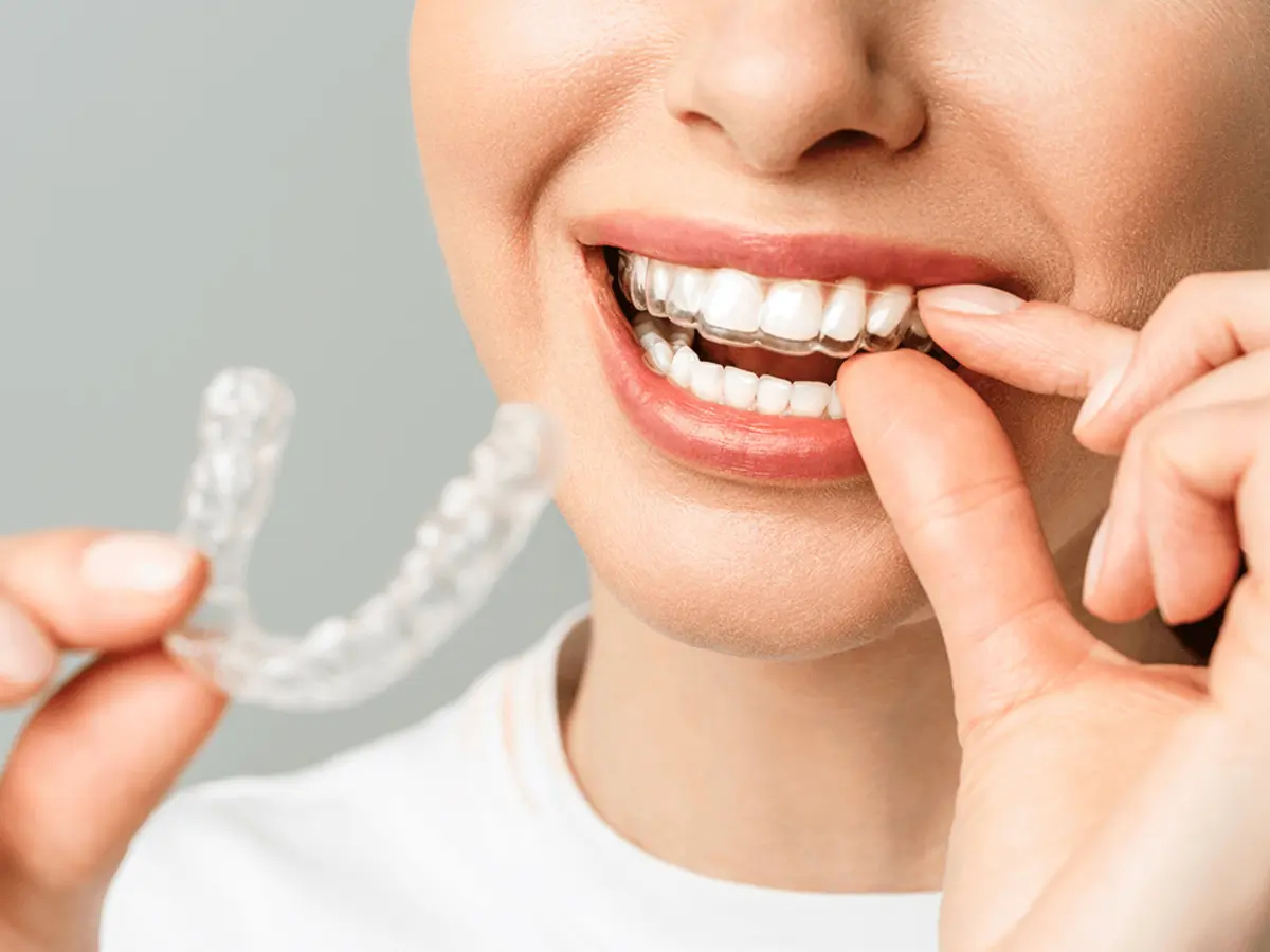 invisible braces treatment cost in mumbai central