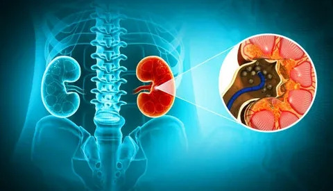organ where kidney stone found
