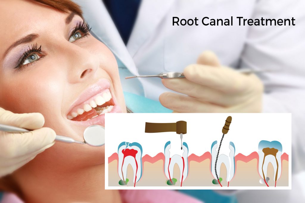 root canal