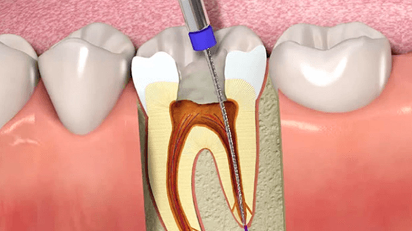 single sitting rct in chula vista
