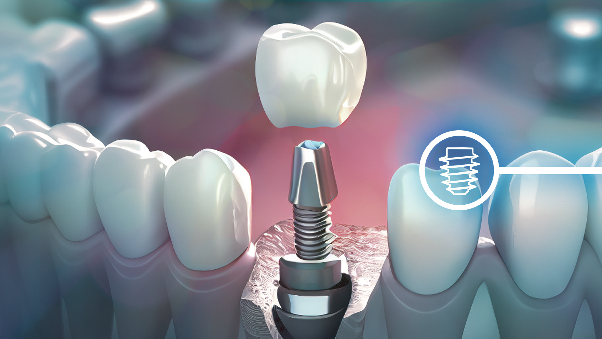 dental implant in sinhagad road