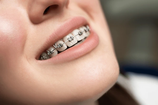 braces treatment in bhubaneswar