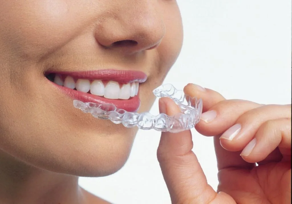 clear aligner