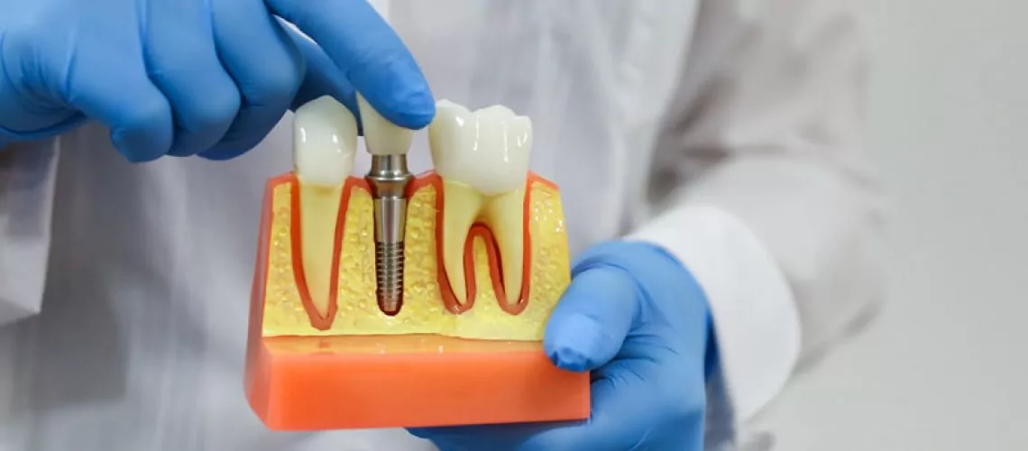 dental implant specialist in hinjewadi