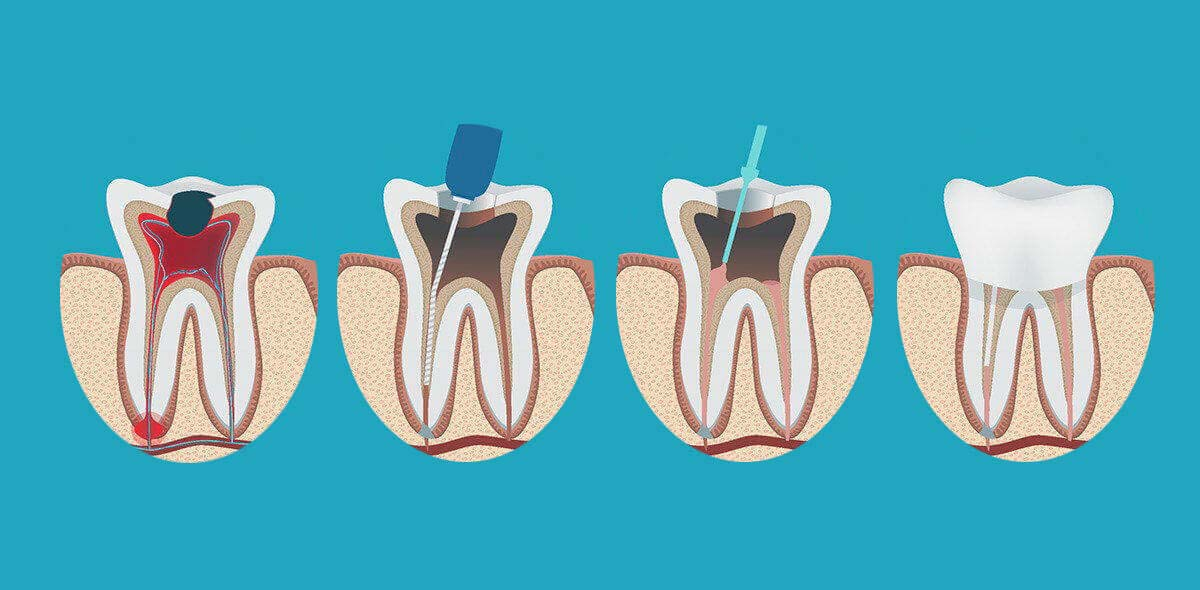 painless root canal treatment in nagpur