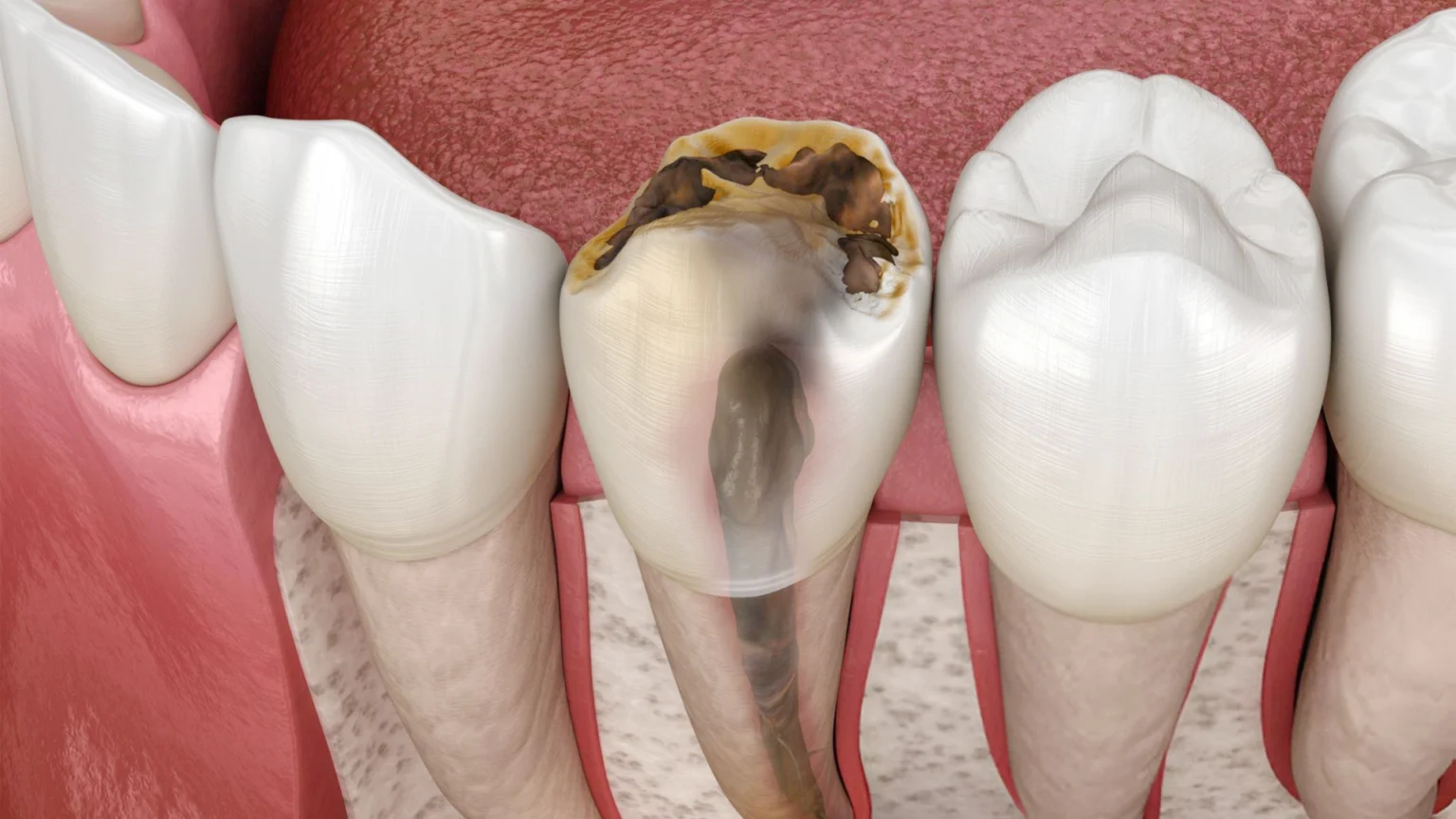 root canal treatment in jamshedpur
