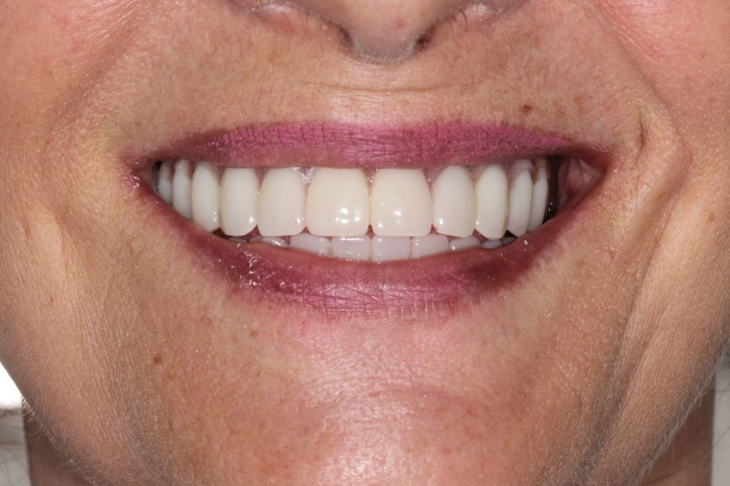 full mouth rehabilitation in Nashik