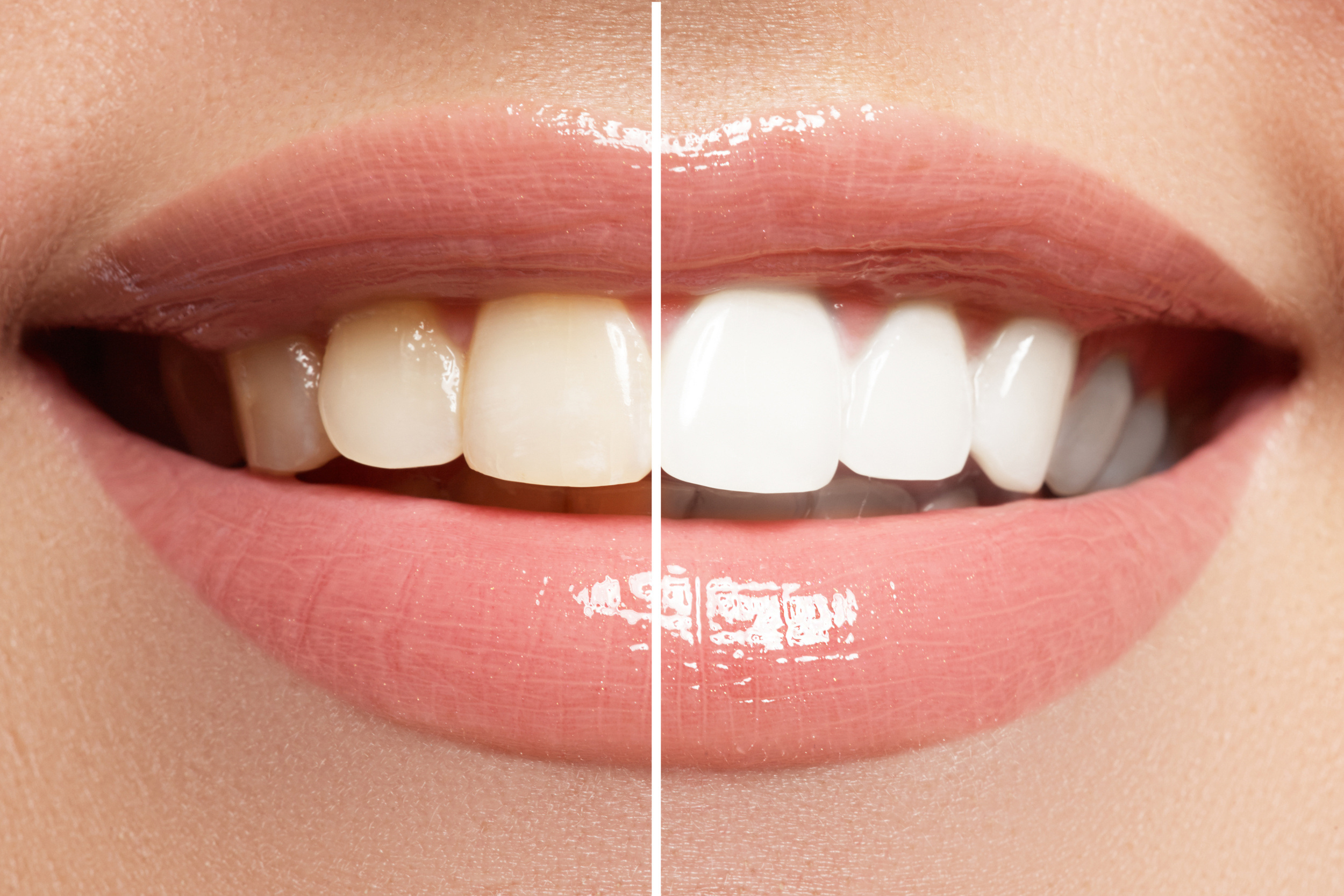 teeth whitening in hinjewadi