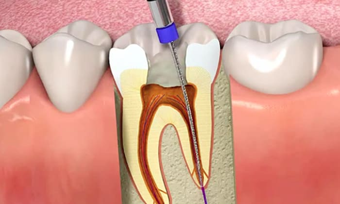 painless root canal treatment in hinjewadi