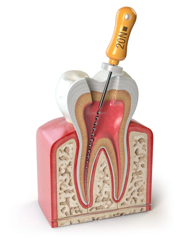 root canal treatment in somalwada
