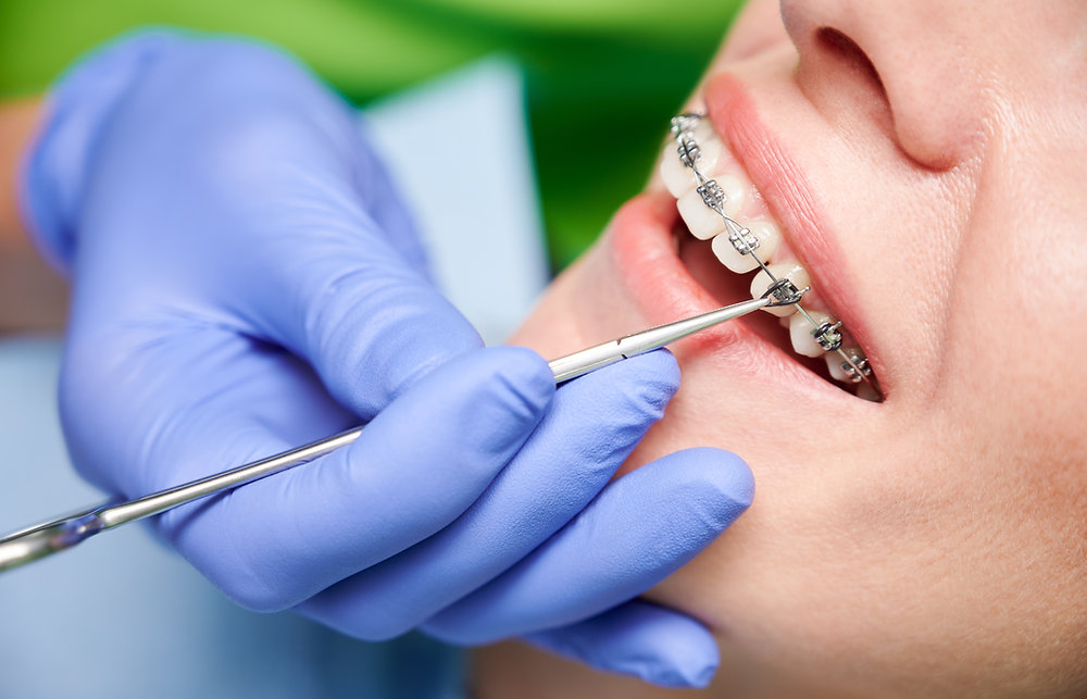braces specialist in Prashant Vihar