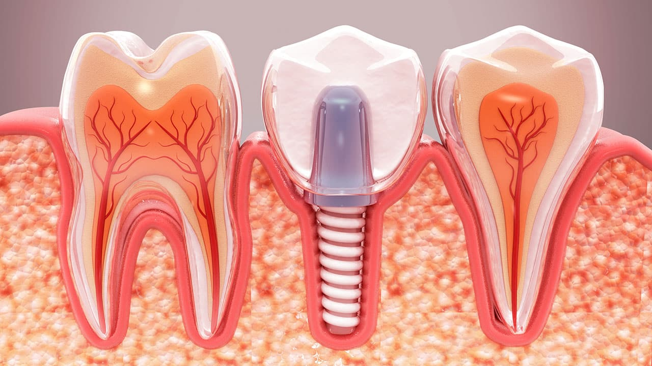 dental implant treatment in madhapur
