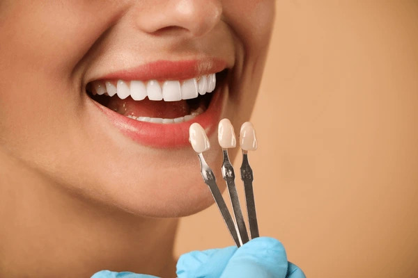 dental veneers in Prashant Vihar