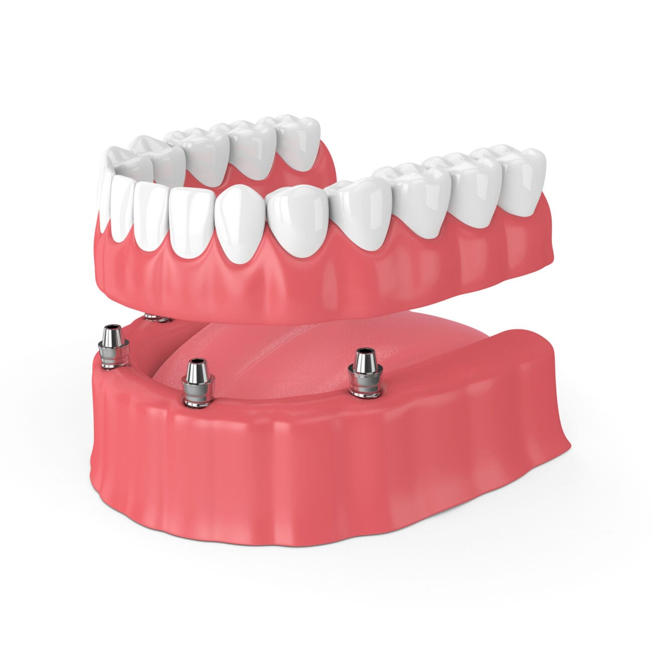 full mouth implant cost in jamshedpur