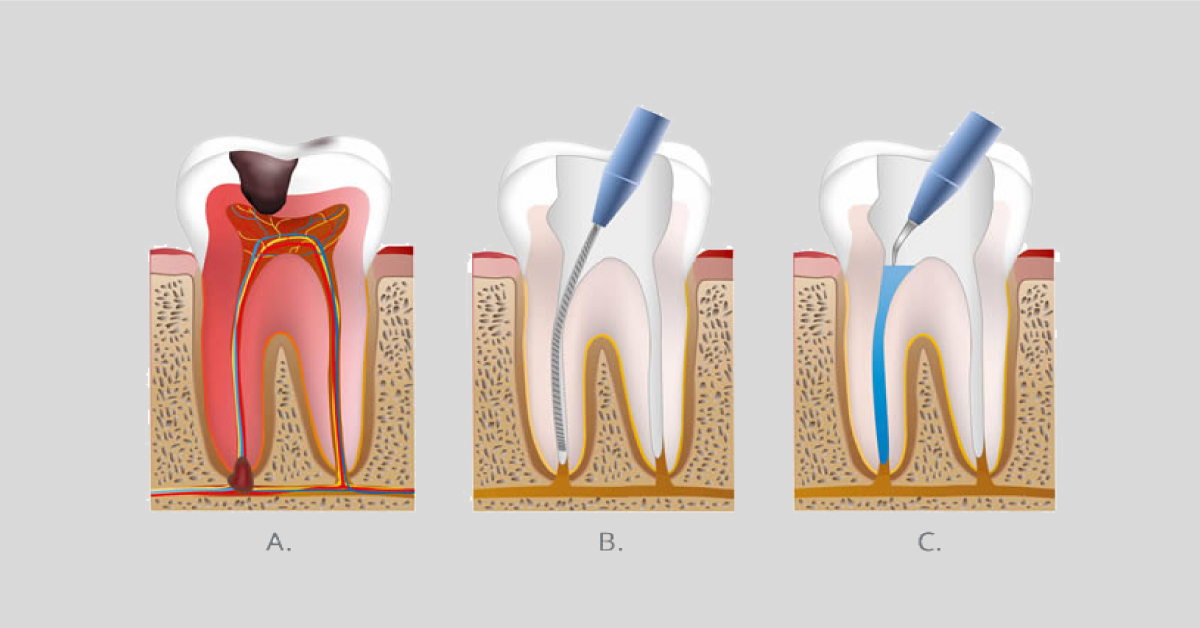 root canal treatment in oshiwara
