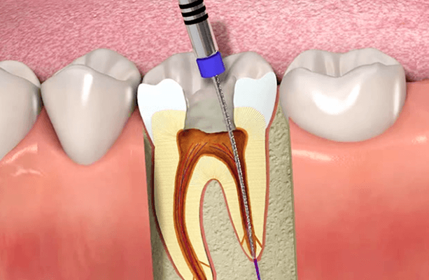 root canal treatment in jamshedpur