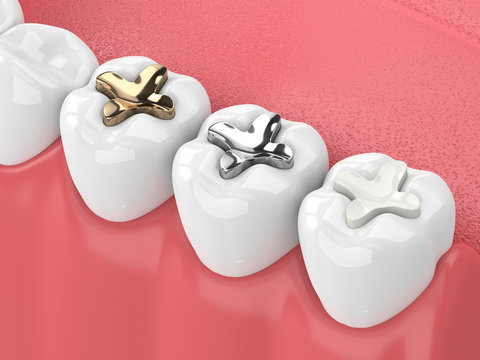 tooth colored filling in Prashant Vihar