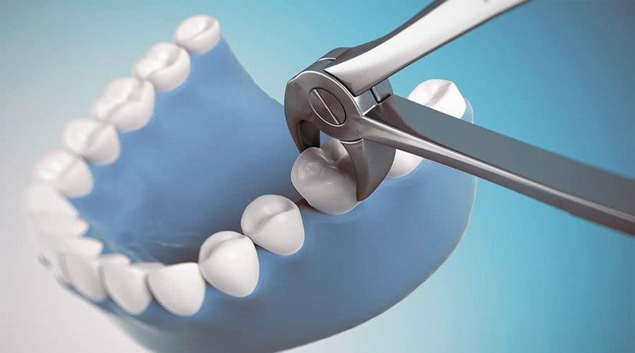 wisdom tooth removal in vivekanand nagar