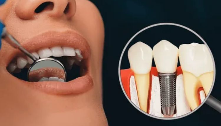 dental implant procedure explained: from consultation to placement