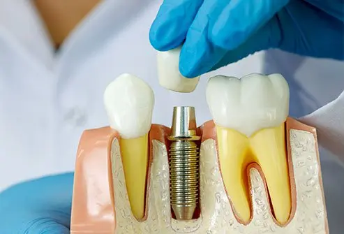 dental implants in Matunga