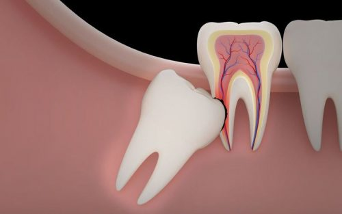 Wisdom Tooth Removal in Prashant Vihar