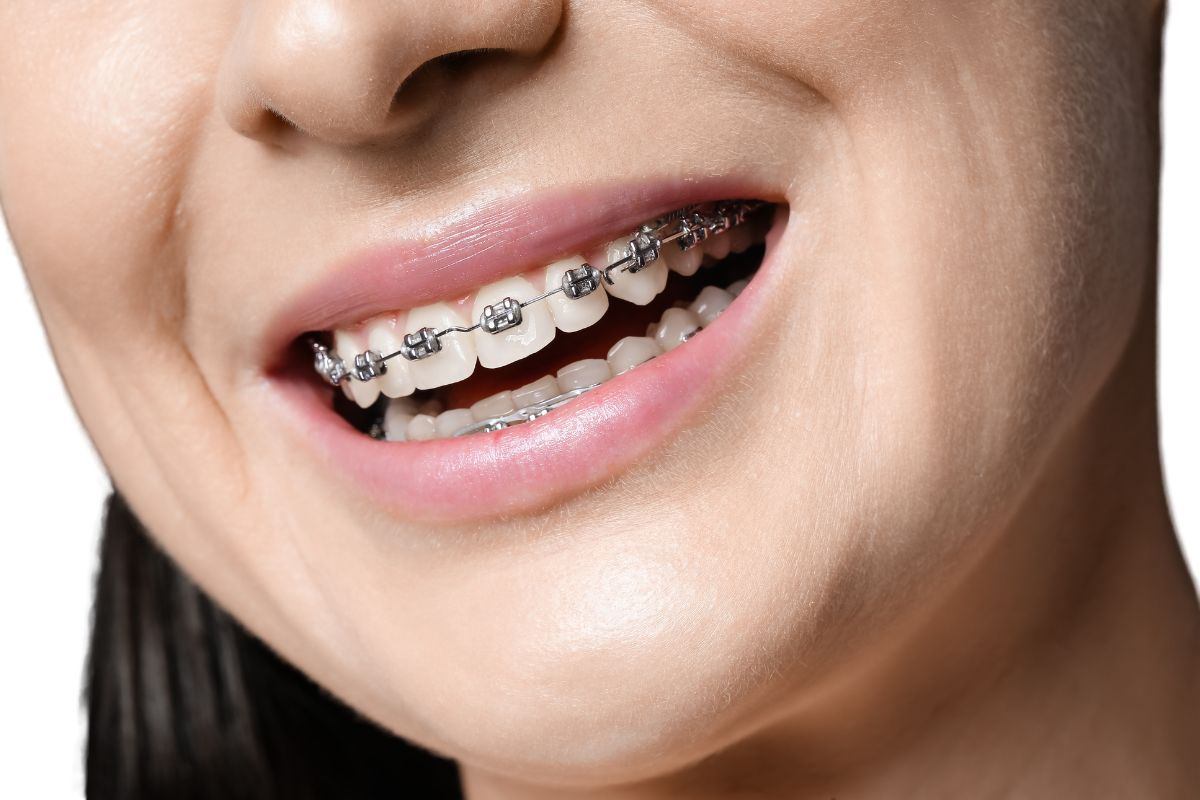 braces treatment cost in Wanowrie