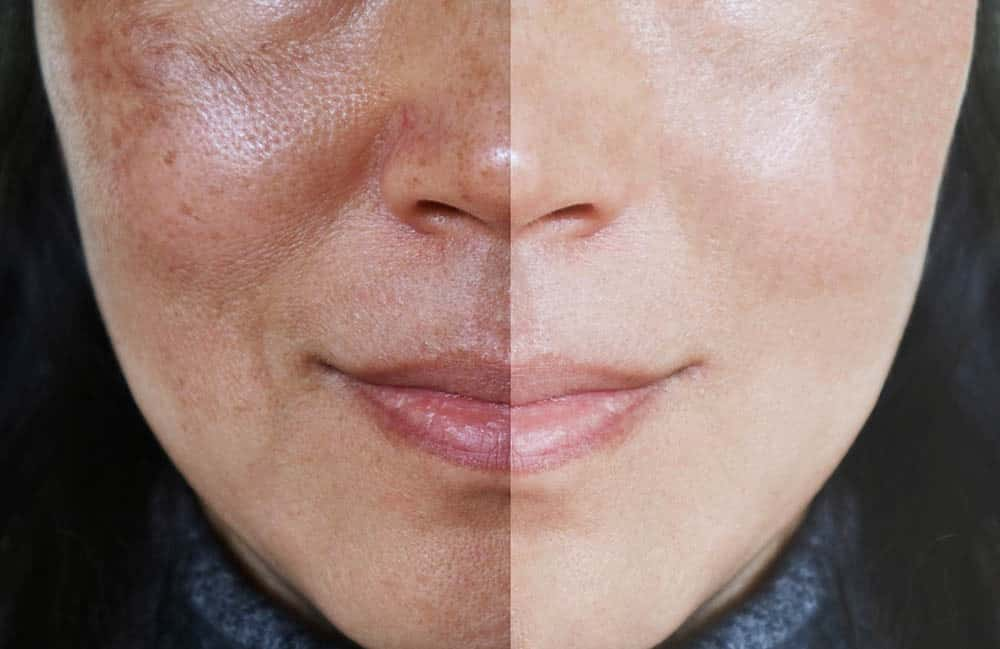 laser pigmentation treatment