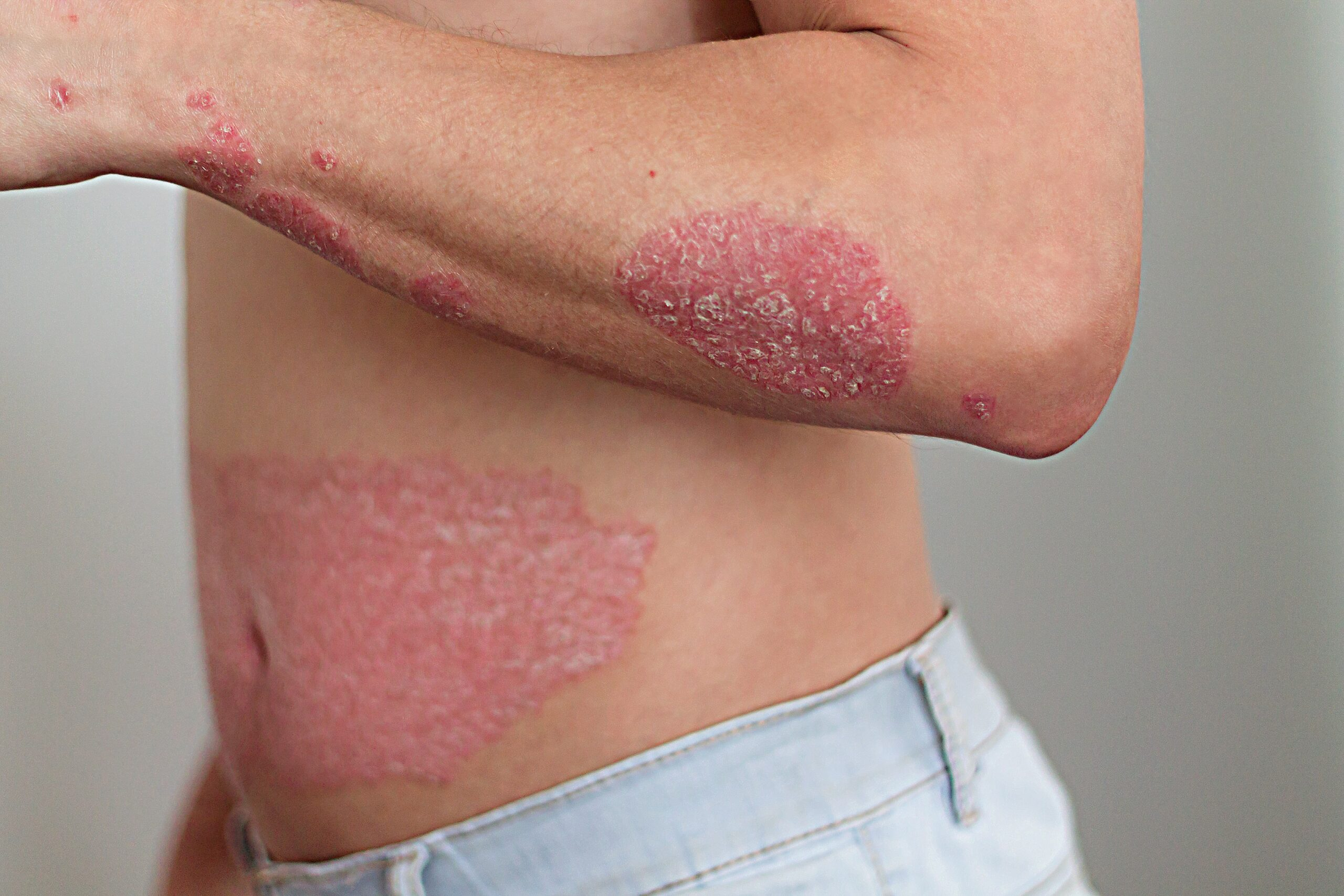 best psoriasis treatment in Noida