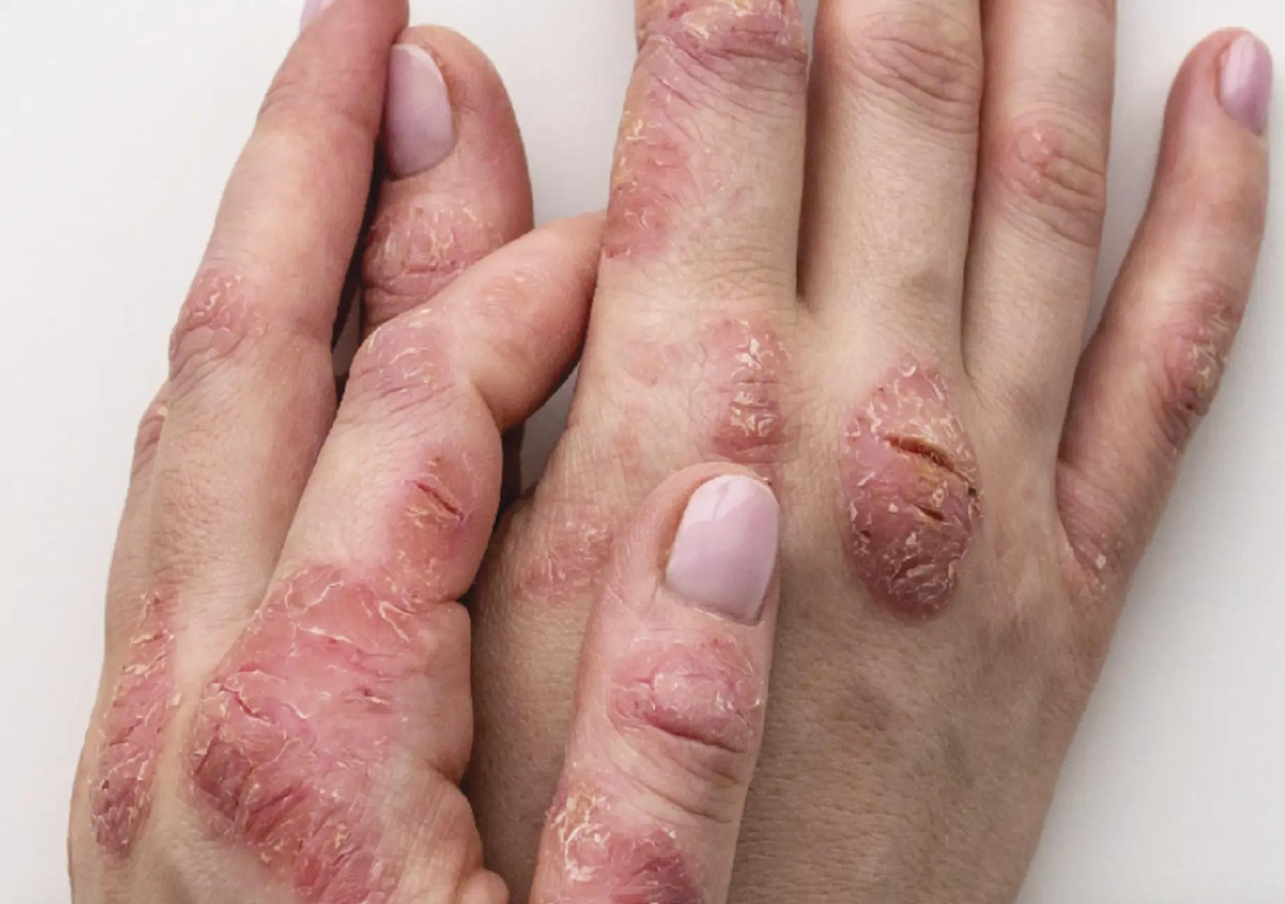 eczema treatment in indirapuram