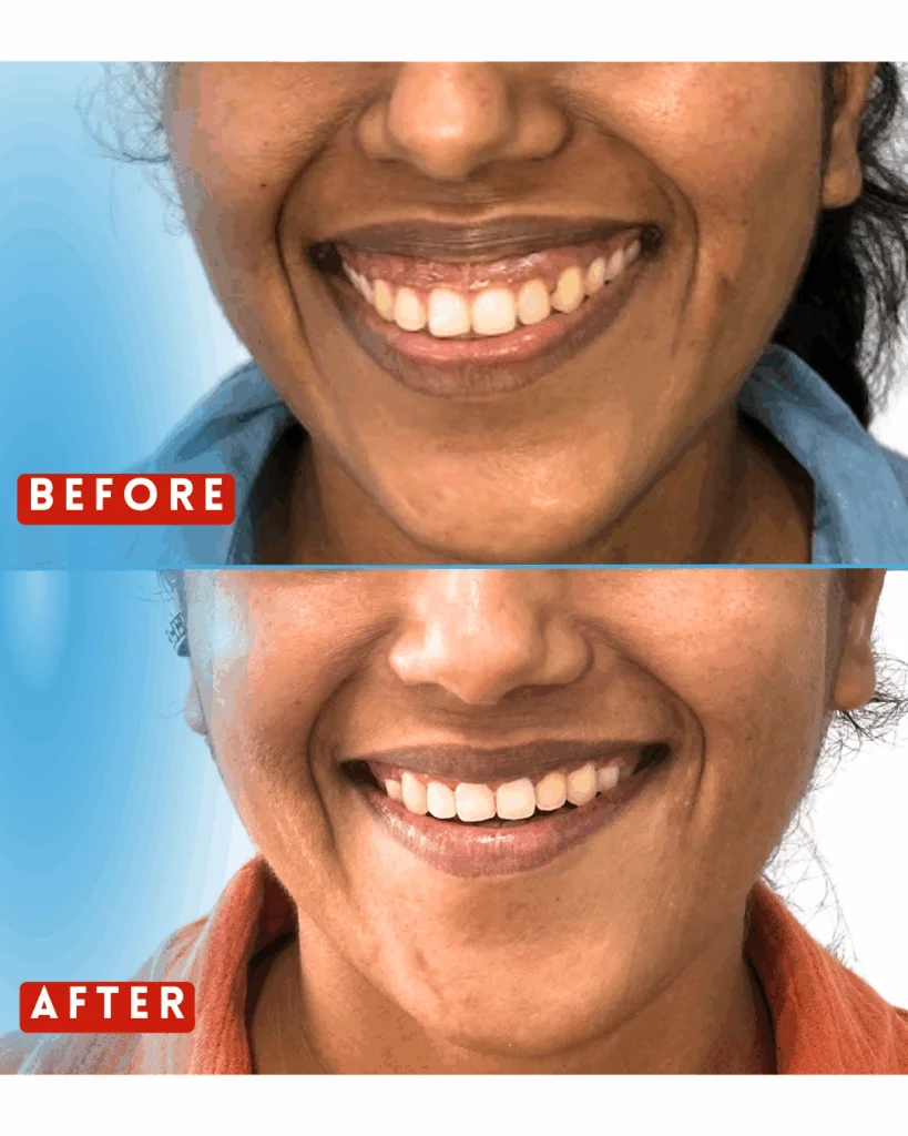 smile makeover in bandra